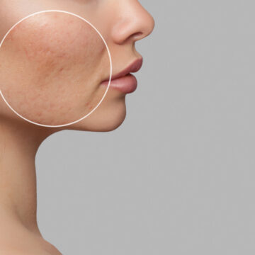 Microneedling for Acne Scars: A Fresh Start for Your Skin