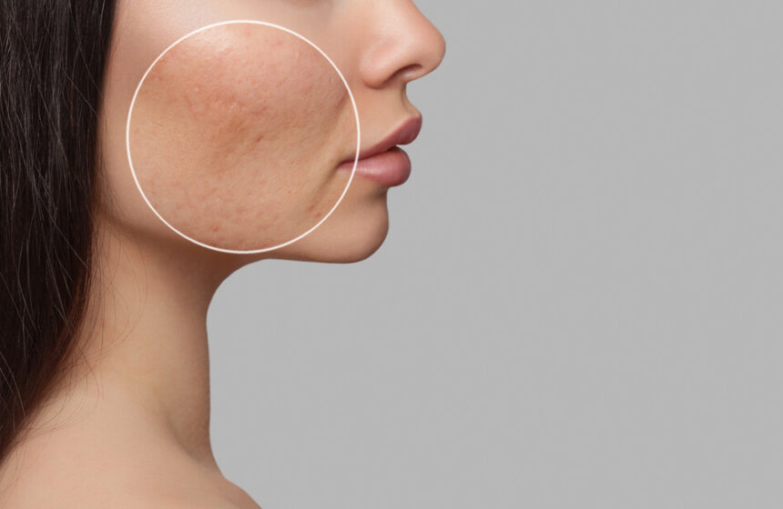 Microneedling for Acne Scars: A Fresh Start for Your Skin